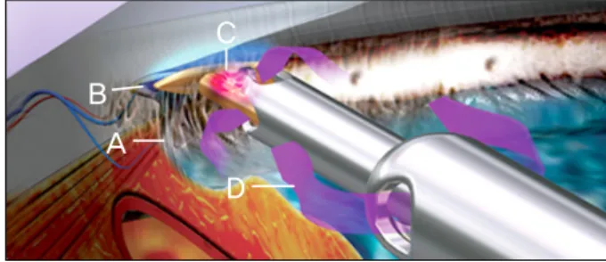 Figure 4. Trabectome handpiece design. (A) Irrigation port  for a stable anterior chamber