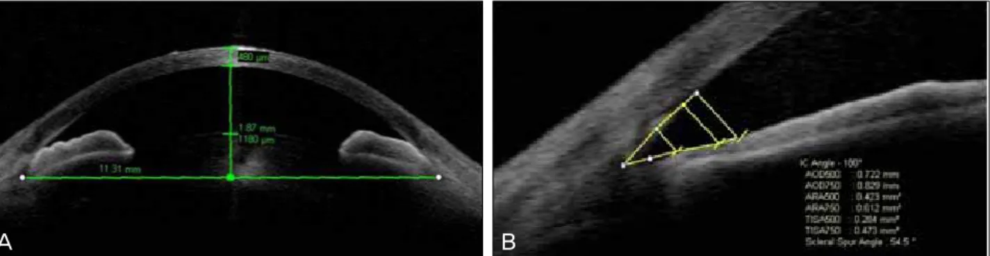 Figure 1. (A) Optical coherence tomography image (Visante OCT) with graphic tools for measurement of different anterior chamber  dimensions