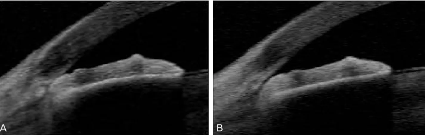 Figure 2. Angle changes of AS-OCT before and after laser peripheral iridotomy. (A) AS-OCT image showing angle closure before  laser peripheral iridotomy