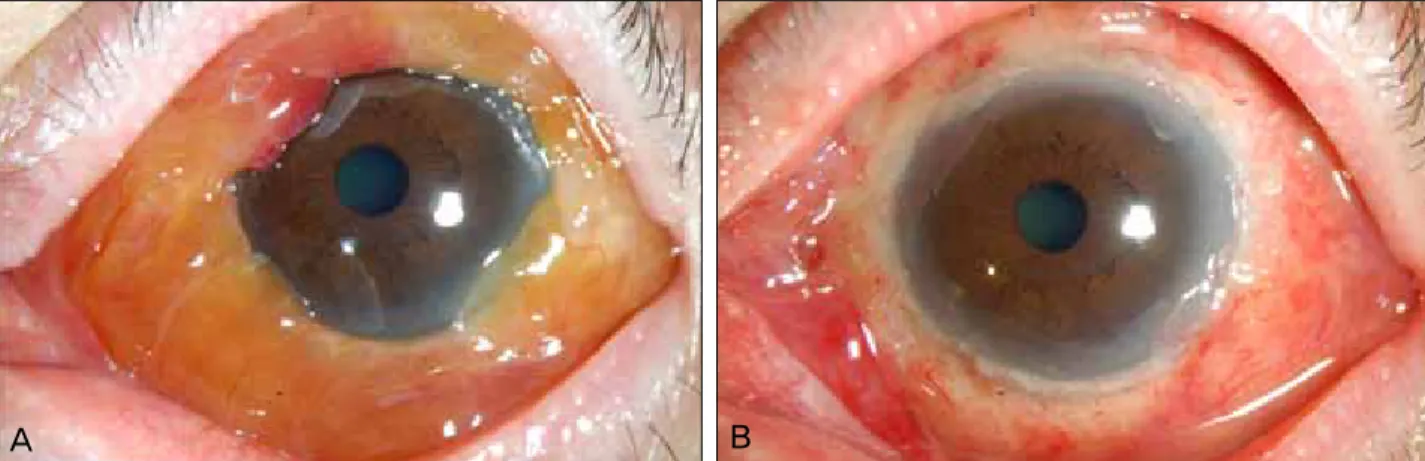 Figure 3. External findings of left eye before mass excision (A) and after treatment with cryotherapy and mass excision (B).