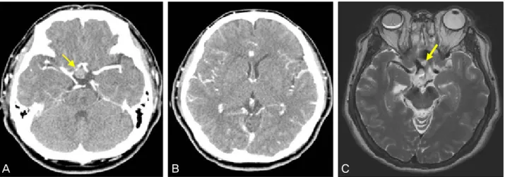Figure 2. (A) Left temporal hemianopia of the left eye. Visual  acuity was 1.0. (B) 1 month later, after migration of silicone  oil into lateral ventricle, the visual field defect improved.