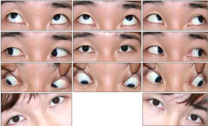 Figure 1. Photographs of nine cardinal gazes before operation. The patient’s right eyes had hypertropia and excessive elevation in  adduction and deficient depression in adduction