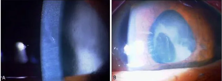 Figure 2. Photograph, 1 day after cataract surgery of case 6. 