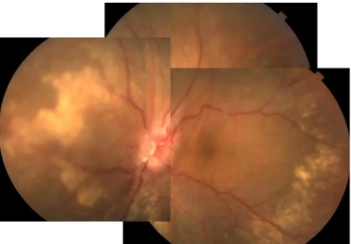 Figure 1. A 75-year-old man without axial proptosis.