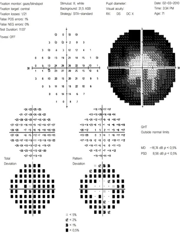 Figure 1. Imminent visual field defect in Humphrey visual field test. 체 삽입술을 시행 받았다.  내원 당시 안구 동통은 없었고  초진 시 안 소견은 나안시력 우안 0.63,  좌안 0.32이었다