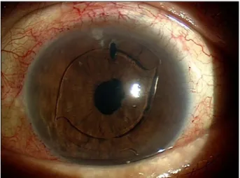 Figure 2. The left eye on the visit. The left eye had received  anterior chamber lens insertion and iridectomy and the posterior capsule had already ruptured