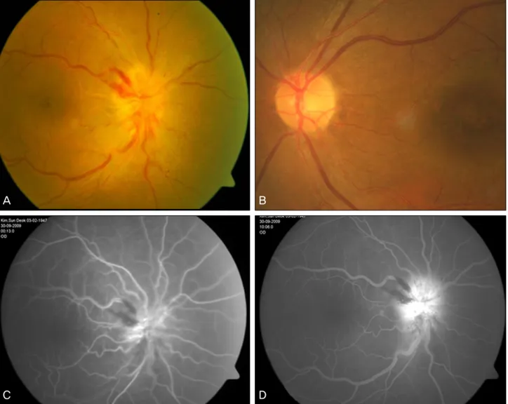 Figure 1. Fundus photographs at the initial visit shows the optic disc edema with hemorrhage in the right eye (A) and cup-disc ratio  of 0.34 in the left eye (B)