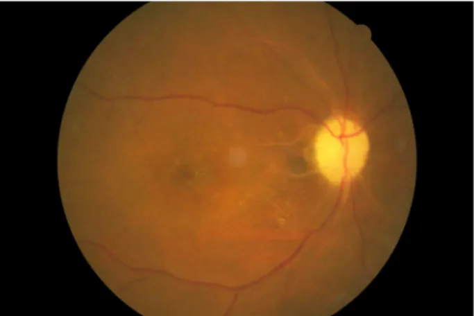 Figure 2. Visual evoked potential (VEP) shows that P100 amplitude  of the right eye decreased compared with that of the left eye  and P100 latency of the right eye was equal to that of the left  eye.