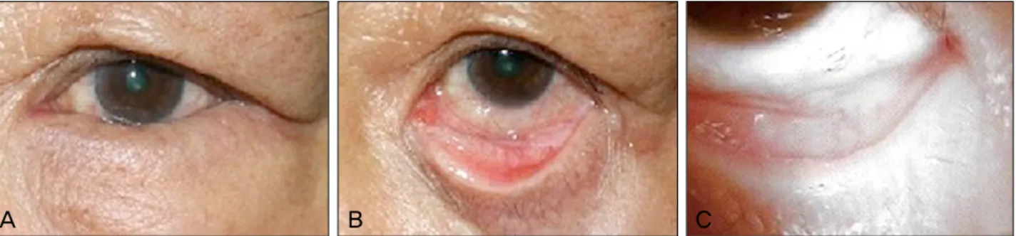 Figure 2. Entropion of both lower eyelids with kinked tarsus  in the left lower eyelid and weakened capsulopalpebral fascia  in the right lower eyelid in a 77 year old female patient