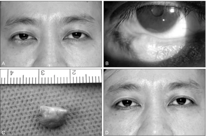 Figure 1. (A) Photograph of the patient demonstrating a 7×7-mm-sized mass in the margin of the right lower eyelid