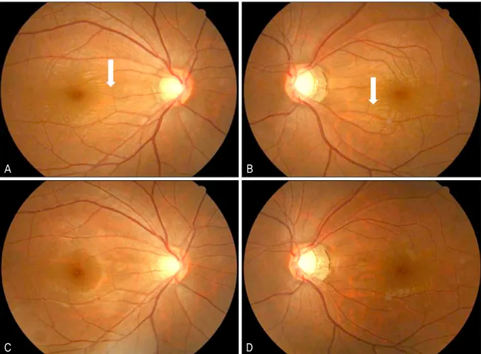 Figure 2. Fundus photographs after use of phentermine hydrochloride for 3 weeks showed retinal folds at perimacular area (A,  B)