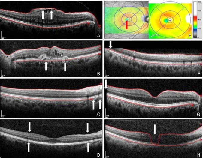 Figure 2. Types of artifacts. (A) Inner retina misidentification. (B) Outer retina misidentification