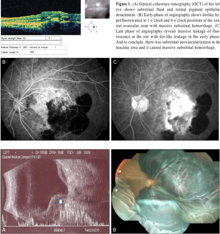 Figure 1. (A) Optical coherence tomography (OCT) of her left  eye shows subretinal fluid and retinal pigment epithelial  detachment