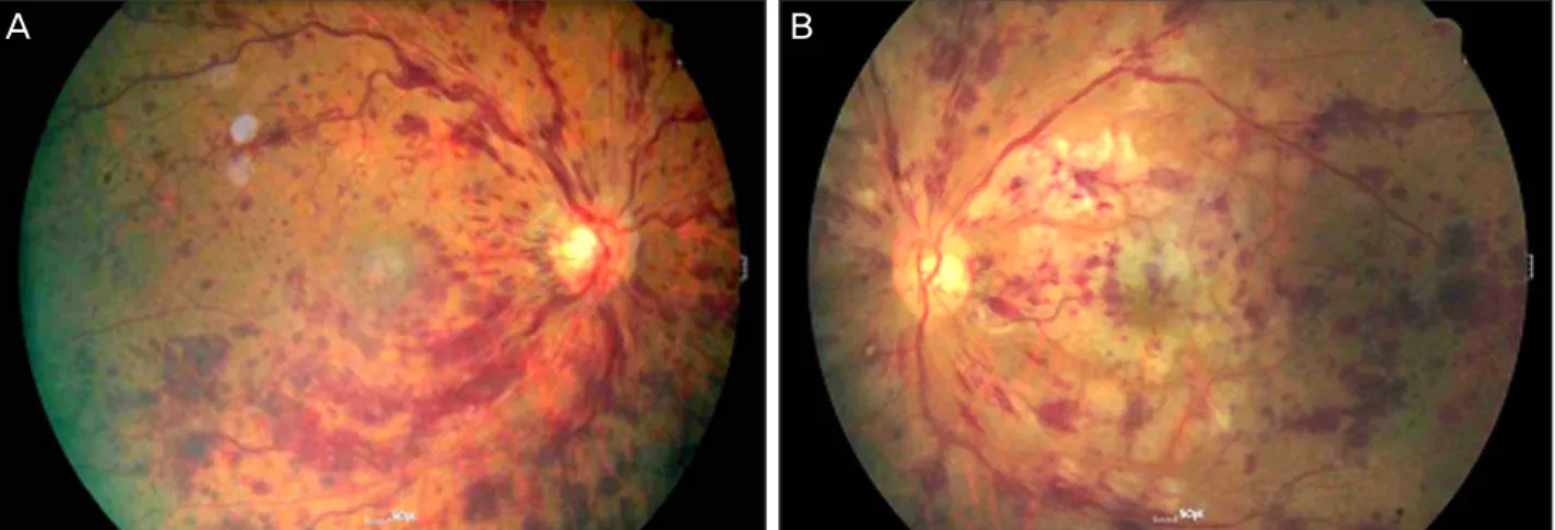 Figure 1. Fundus photographs show dilated tortuous veins and diffuse retinal hemorrhages in the right eye (A) and left eye (B).
