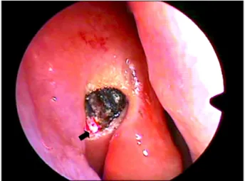 Figure 2. Intranasal view during TCL-DCR using diode laser  (Black arrow shows Laser probe tip)
