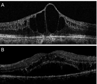 Figure 1. Classification of macular edema based on optical co- co-herence tomography in retinal vein occlusion