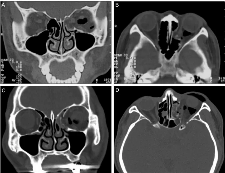 Figure 1. Large medial orbital wall fractures of the left eye are shown on the preoperative CT
