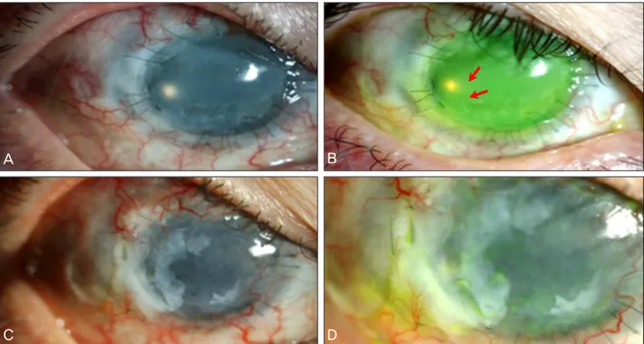 Figure 1. (A, B) Slit lamp photograph shows total limbal cell deficiency and perforation at 8 to 9 o’clock (red arrows), (C, D)  Anterior segment photograph shows that the ocular surface is well maintained well and graft remains healthy at postoperative 6 
