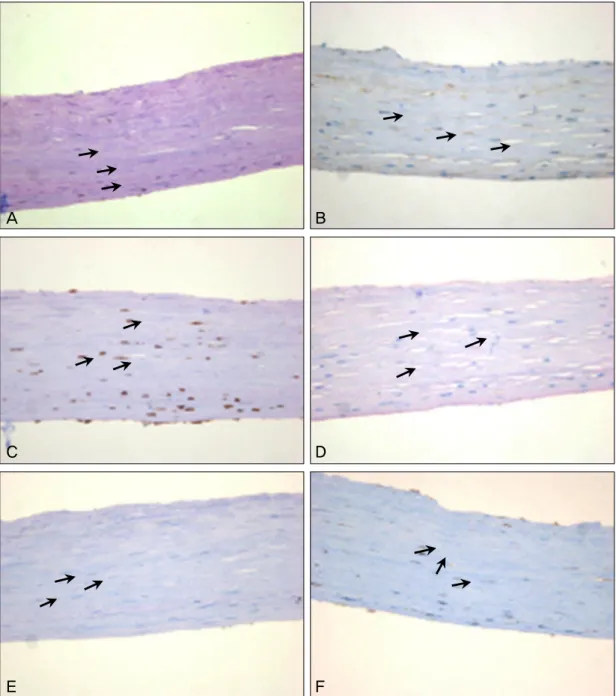 Figure 2. Transplanted amniotic membrane biopsy shows many mesenchymal stem cells. (A) c-kit (B) CD29  (integrin-β-1) (C) SMA (D) hSTRO-1 (E) VEGF (F) vimentin (×400).