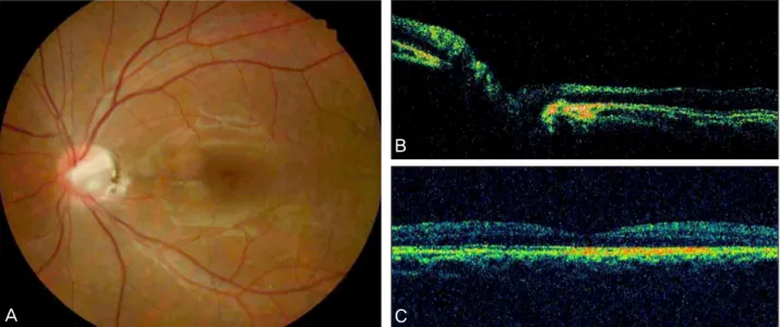 Figure 3. Fundus photograph (A) and optical coherence tomography image (B, C) of the left eye reveals complete attached macula  at two years after only gas tamponade procedure.