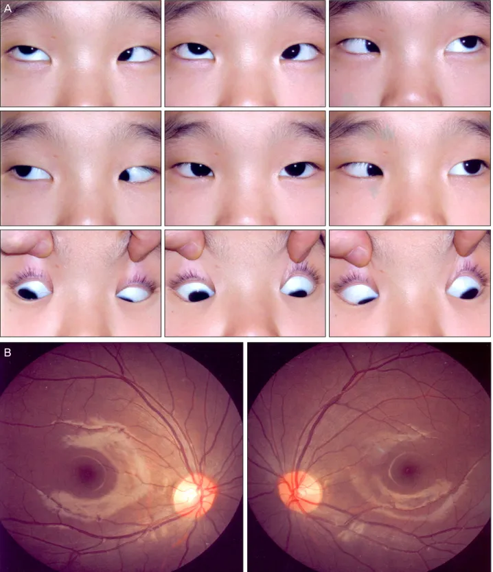 Figure 3. (A) Postoperative 3 year 5 months 9-cardinal photos after secondary operation; Right lateral rectus muscle advancement  (5.0 mm) and right inferior oblique muscle exploration