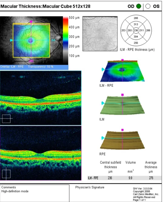 Figure 1. Standard output of  Cirrus OCT, 512 × 128  mac-ular cube (version 3.0.0.64,  Carl Zeiss Meditec).