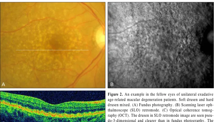 Figure 2. An example in the fellow eyes of unilateral exudative  age-related macular degeneration patients