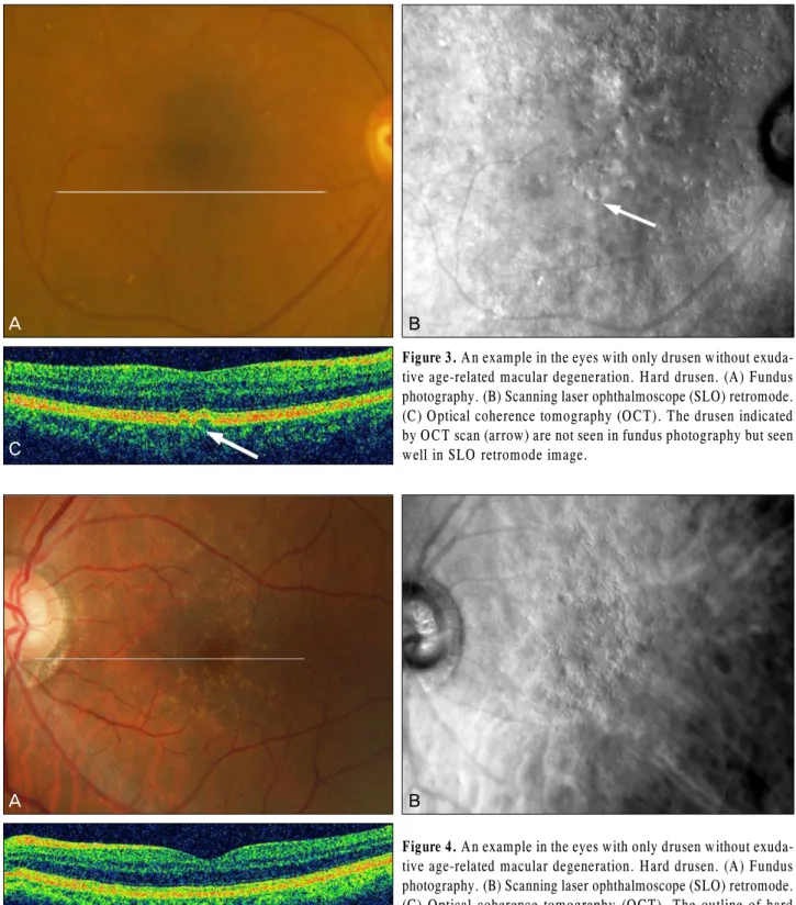 Figure 4. An example in the eyes with only drusen without exuda- exuda-tive age-related macular degeneration