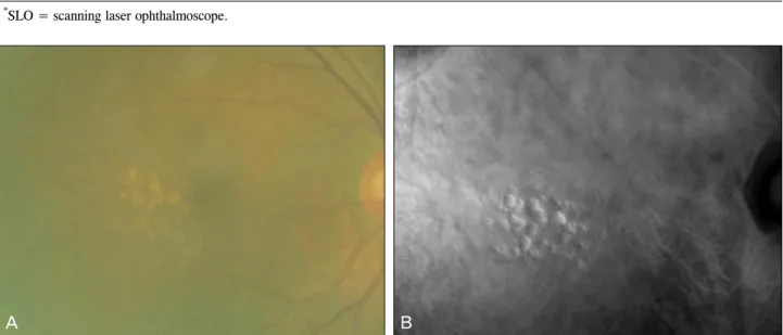 Figure 5. Drusen with the media opacity. (A) Fundus photography. (B) Scanning laser ophthalmoscope (SLO) retromode