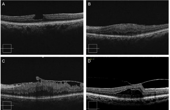 Figure 1. The intraretinal structures of patients with macular ERM in Cirrus-HD OCT. (A) Pseudohole at fovea, (B)  Diffuse retinal thickening of retina with globally adherent ERM, (C) Retinal fold with partially adherent ERM, (D)  Vitreomacular traction wi