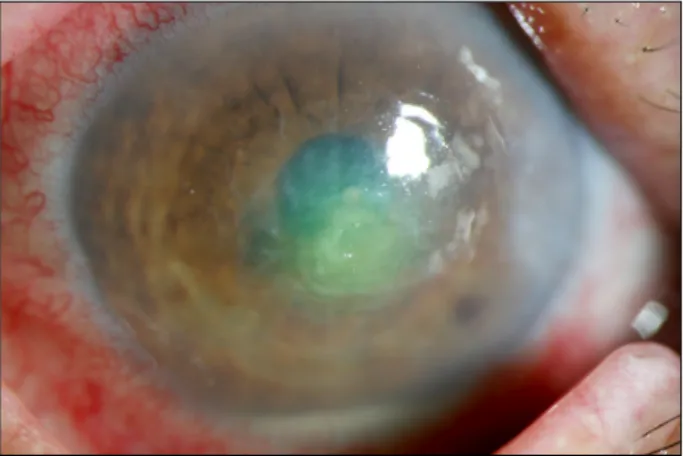 Figure 1. Corneal ulcer with deep stromal infiltration and line- line-ar hypopyon were observed on initial presentation.