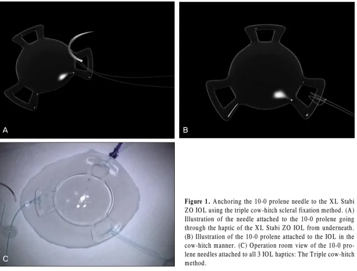 Figure 1. Anchoring the 10-0 prolene needle to the XL Stabi  ZO IOL using the triple cow-hitch scleral fixation method