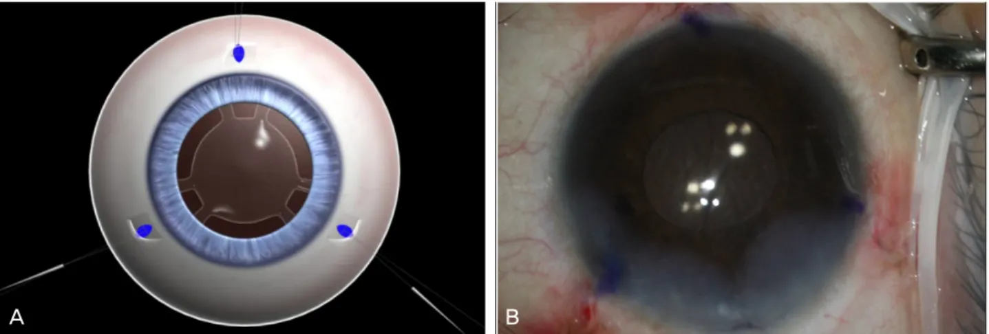 Figure 5. Final adjustment of the IOL. (A) Illustration of the IOL prior to being fixed to the scleral wall