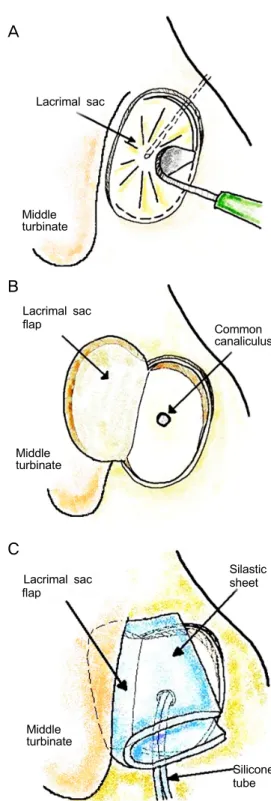 Figure 1. Schematic illustration of creation and reflection of  the U-shaped lacrimal sac flap