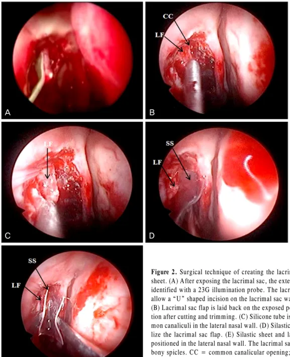 Figure 2. Surgical technique of creating the lacrimal sac flap with silastic  sheet. (A) After exposing the lacrimal sac, the extent of the lacrimal sac was  identified with a 23G illumination probe