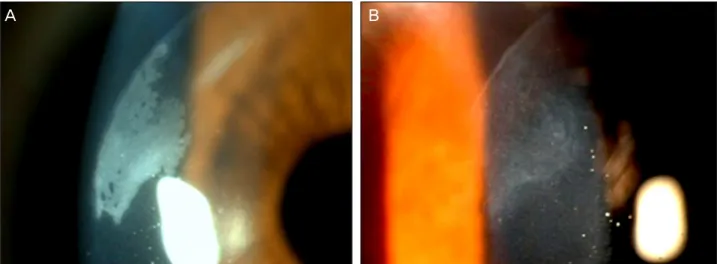 Figure 3. Epithelial ingrowth does not improve or aggravate. (A) 8 days after LASIK. (B) 22 days after LASIK.