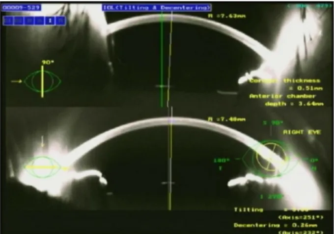 Figure 3. Uncorrected distant visual acuity after WIOL-CF®