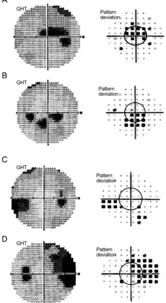 Figure 2. Examples of visual field defect evaluation on visual  field gray scale and pattern deviation scale (A, B) Central field  defects, (C, D) Peripheral field defects