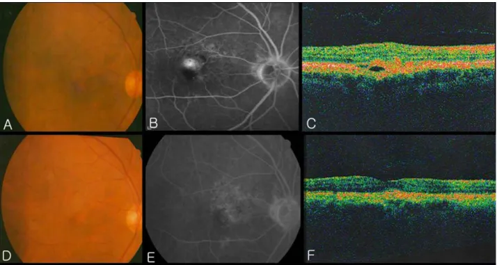 Figure 2. A 71-year–old-man with visual loss in his right eye was diagnosed with neovascular age-related macular  degeneration