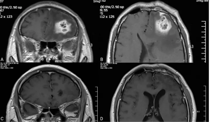 Figure 3. (A, B) T1-weighted MRI scans. Newly developed enhancing multilocular lesion (abscess) and surrounding  edema in left forntal lobe