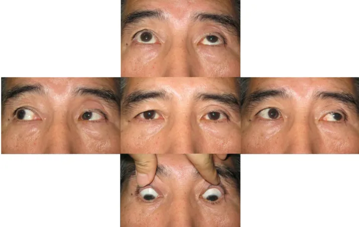Figure  4. Photographs  at  final  visit.  Almost  recovered  restriction  of  left  eye  movement