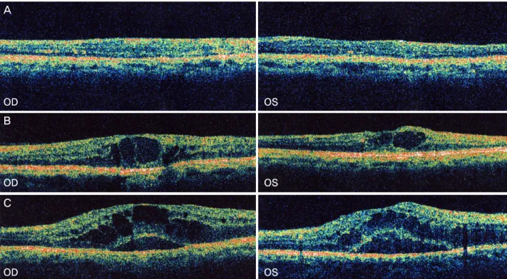 Figure 1. The classification of diabetic macular edema on optical coherent tomographic images