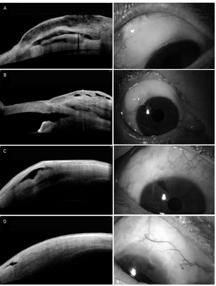 Figure  2. AS-OCT image and corresponding slit-lamp appearance. (A)  Diffuse functioning  bleb