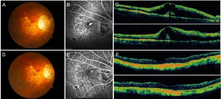 Figure  4. Bevacizumab  was  injected  intravitreally  two  times  at  an  interval  of  two  months  for  myopic  choroidal  neovascularization  (CNV)  in  the  right  eye  of  a  69-year-old  woman