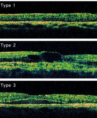 Figure 1. Classification of macular edema in branch retinal vein occlusion patients: Type 1, diffuse macular edema