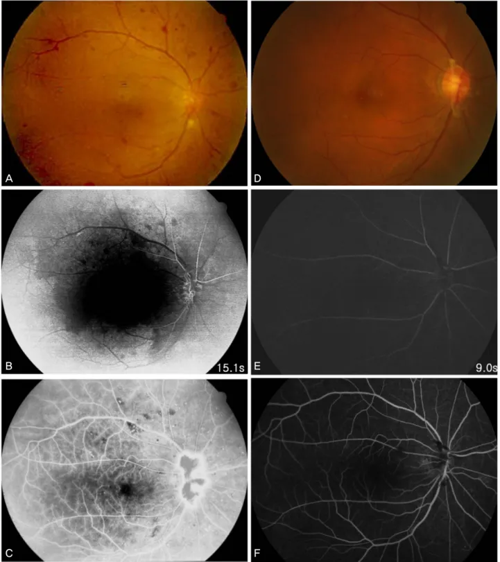 Figure 1. Fundus photograph and fluorescein angiography in the early and late phase before (A, B, C) and after (D,  E,  F)  carotid  angioplasty  and  stenting  (CAS)
