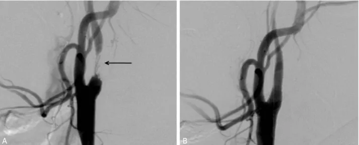 Figure 2. Carotid angiography before (A) and after (B) carotid angioplasty and stenting (CAS)