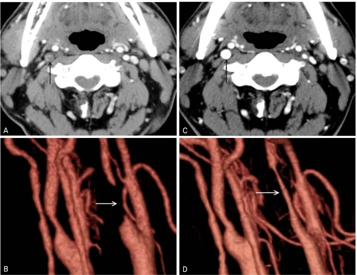 Figure 3. CT angiography and reconstructed three dimensional image before (A, B) and after (C, D) carotid angio-  plasty and  stenting (CAS)