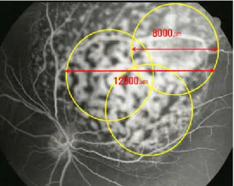 Figure 8. At 22 days after photodynamic therapy, the  fundoscopy shows resolution of serous retinal detatchment  and  marked  tumor  shrinkage.