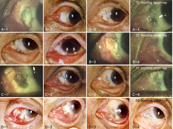 Figure  2. (A,  B,  C,  D-1)  Preoperative  photograph  showing  sclera  thinning  with  exposed  uveal  tissue  at  the  site  of  previous  pterygium  excision